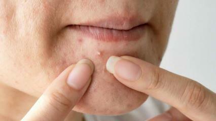 Proč se akné objevuje na bradě? Přírodní řešení pro akné na bradě