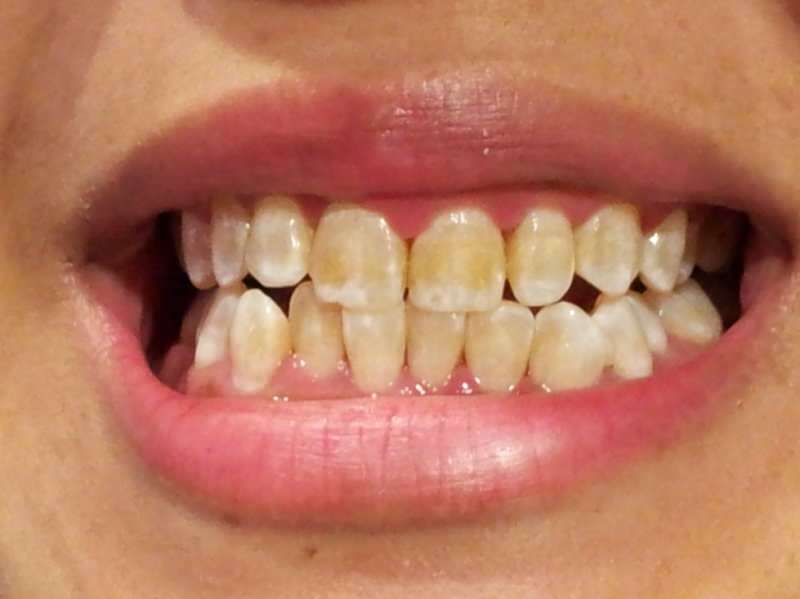 zubní obraz osoby, jejíž zuby začínají ztmavnout