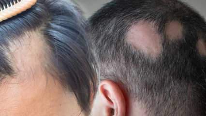 Co je kožního onemocnění (Alopecia areata)? Co jsou to příznaky kožního onemocnění? Efektivní řešení pro kožního onemocnění