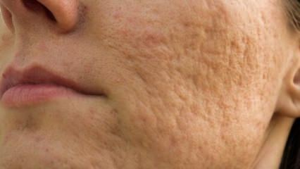 Jak jizvy po akné na obličeji jdou? Recepty masky, které odstraňují jizvy po akné