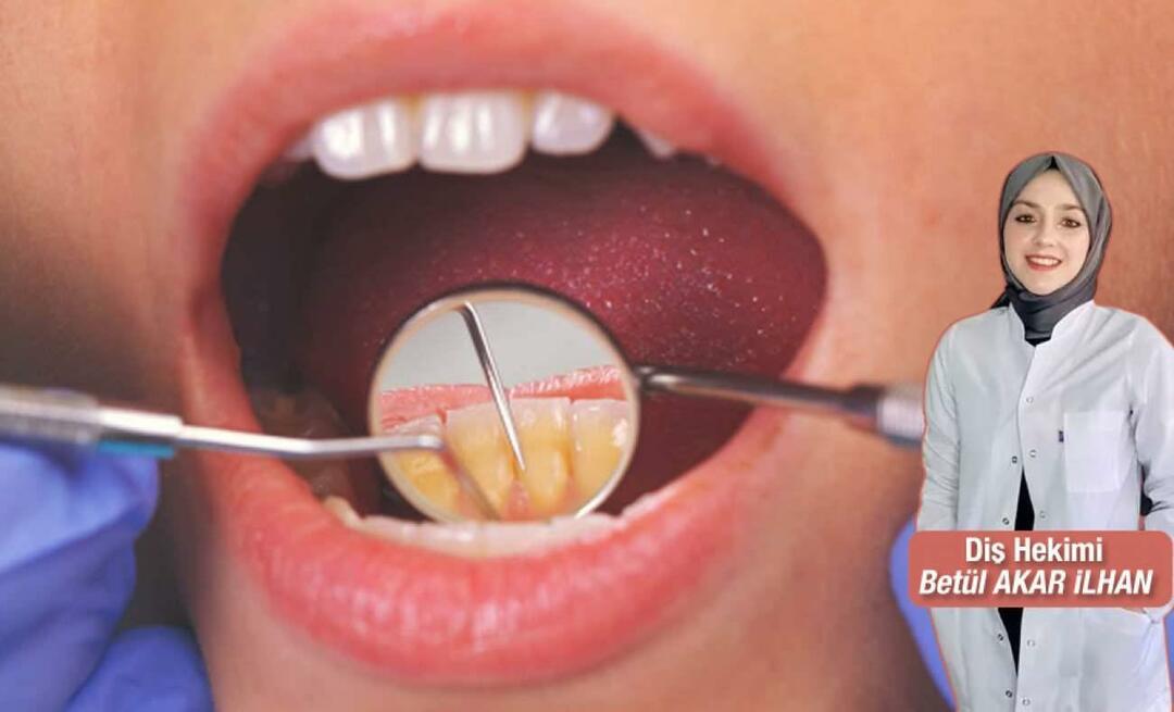 Co dělat, aby se zubní kámen vyhnul? Jaké jsou výhody zubního kamene?