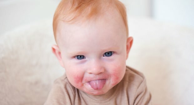 Pozornost u dětí s červenými tvářemi! Syndrom slapané tváře a jeho příznaky