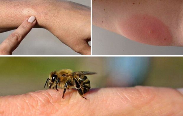 příznaky alergie na včely