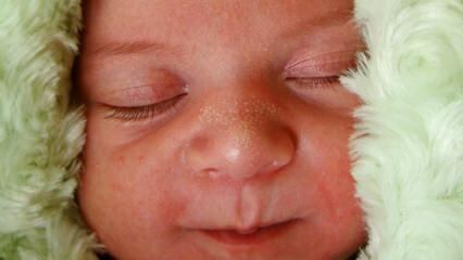 Proč se bílá skvrna objevuje u kojenců?