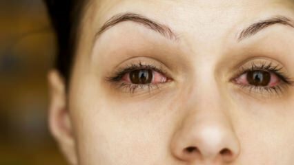Co je zánět spojivek (oční chřipka) a jaké jsou příznaky? Jak se přenáší zánět spojivek?