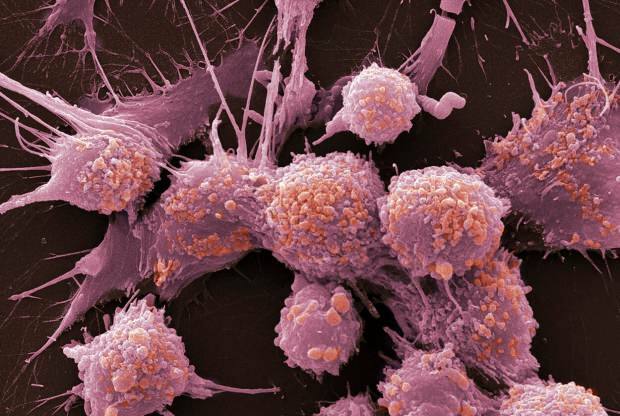 Co je rakovina a jaké jsou její příznaky? Kolik druhů rakoviny existuje? Jak se předchází rakovině?